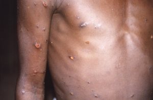 Read more about the article Africans see inequity in monkeypox response elsewhere￼