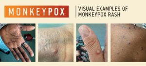 Read more about the article Emergency Committee meets again as Monkeypox cases pass 14,000: WHO￼￼￼￼