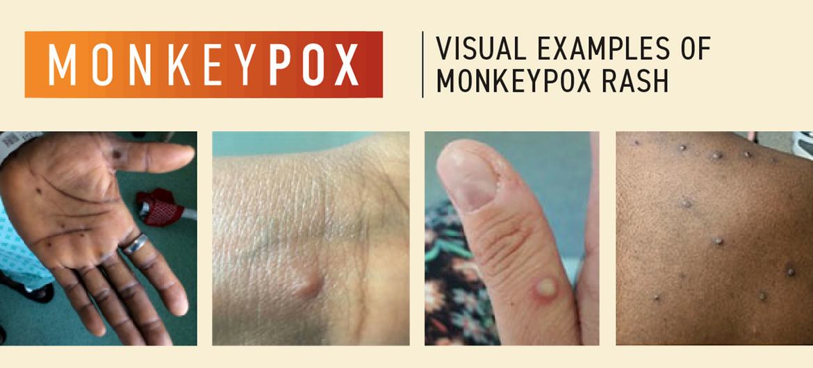 You are currently viewing Emergency Committee meets again as Monkeypox cases pass 14,000: WHO￼￼￼￼