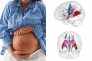 Read more about the article Pregnancy changes the brain in multiple ways