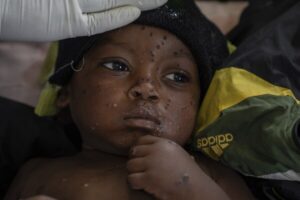 Read more about the article Mpox cases in Congo may be stabilizing. Experts say more vaccines are needed to stamp out virus