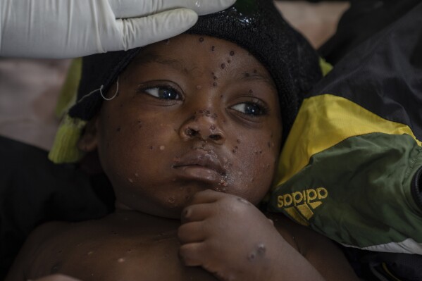 You are currently viewing Mpox cases in Congo may be stabilizing. Experts say more vaccines are needed to stamp out virus