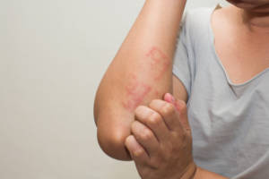 You are currently viewing Air pollution may cause eczema