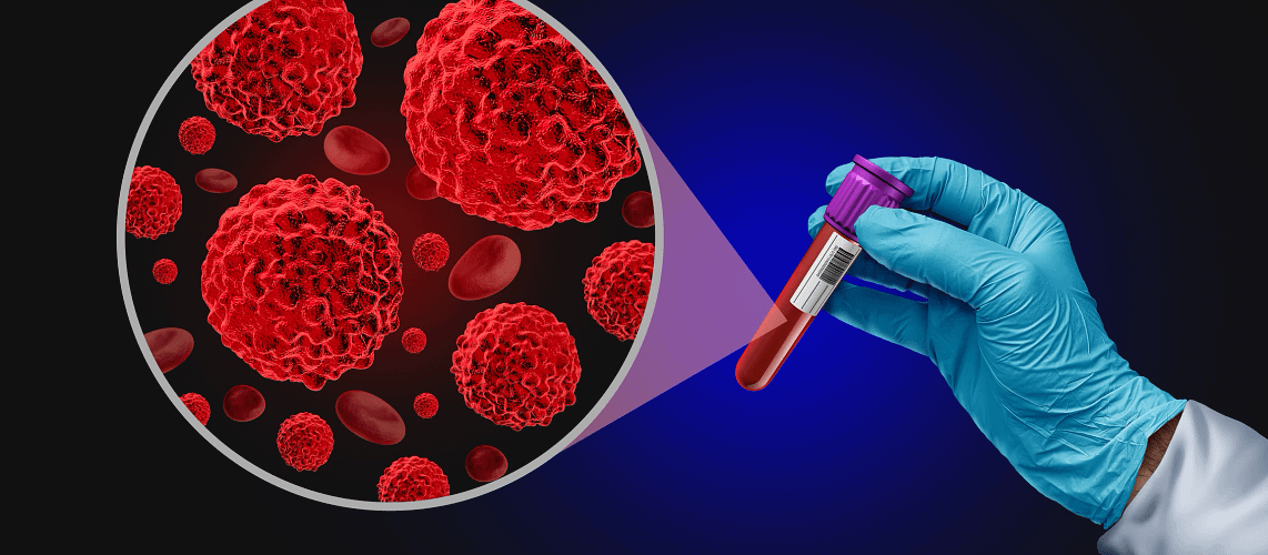 You are currently viewing New blood test may help detect pancreatic cancer sooner