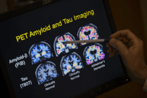 Read more about the article FDA OKs first blood test that can help diagnose Alzheimer’s disease
