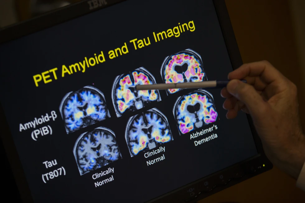 You are currently viewing FDA OKs first blood test that can help diagnose Alzheimer’s disease