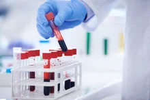 Read more about the article Tau Test Can Identify People With Preclinical Alzheimer’s Disease