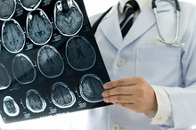 Read more about the article Elevated PTSD Symptoms More Common After Stroke Mimics Than Actual Stroke