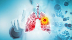 Read more about the article A major review finds vaping likely causes lung and oral cancer