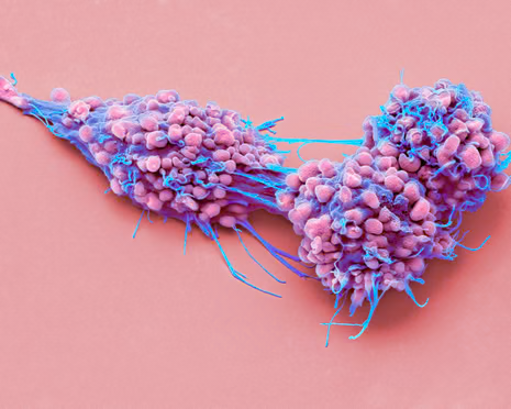 You are currently viewing Ovarian cancer drug may extend life and improve quality of life