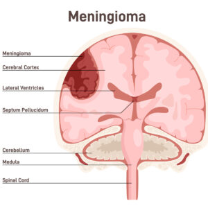 Read more about the article Depo-Provera and other hormonal contraceptives are linked to brain tumors