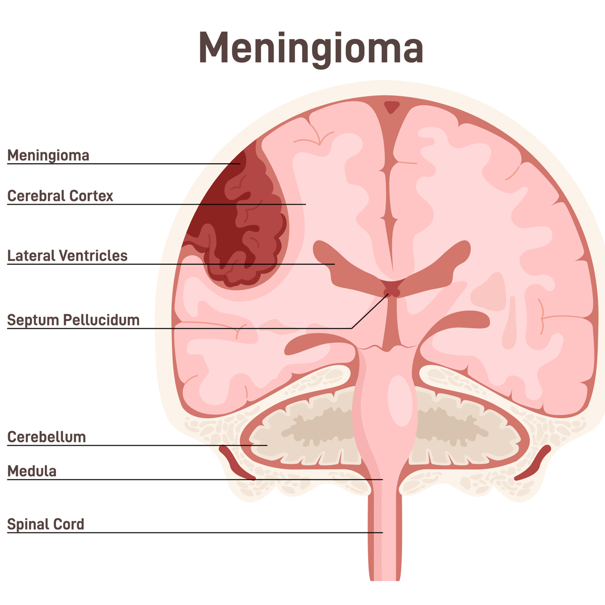 You are currently viewing Depo-Provera and other hormonal contraceptives are linked to brain tumors