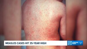 Read more about the article U.S. measles cases reach their highest level in 35 years