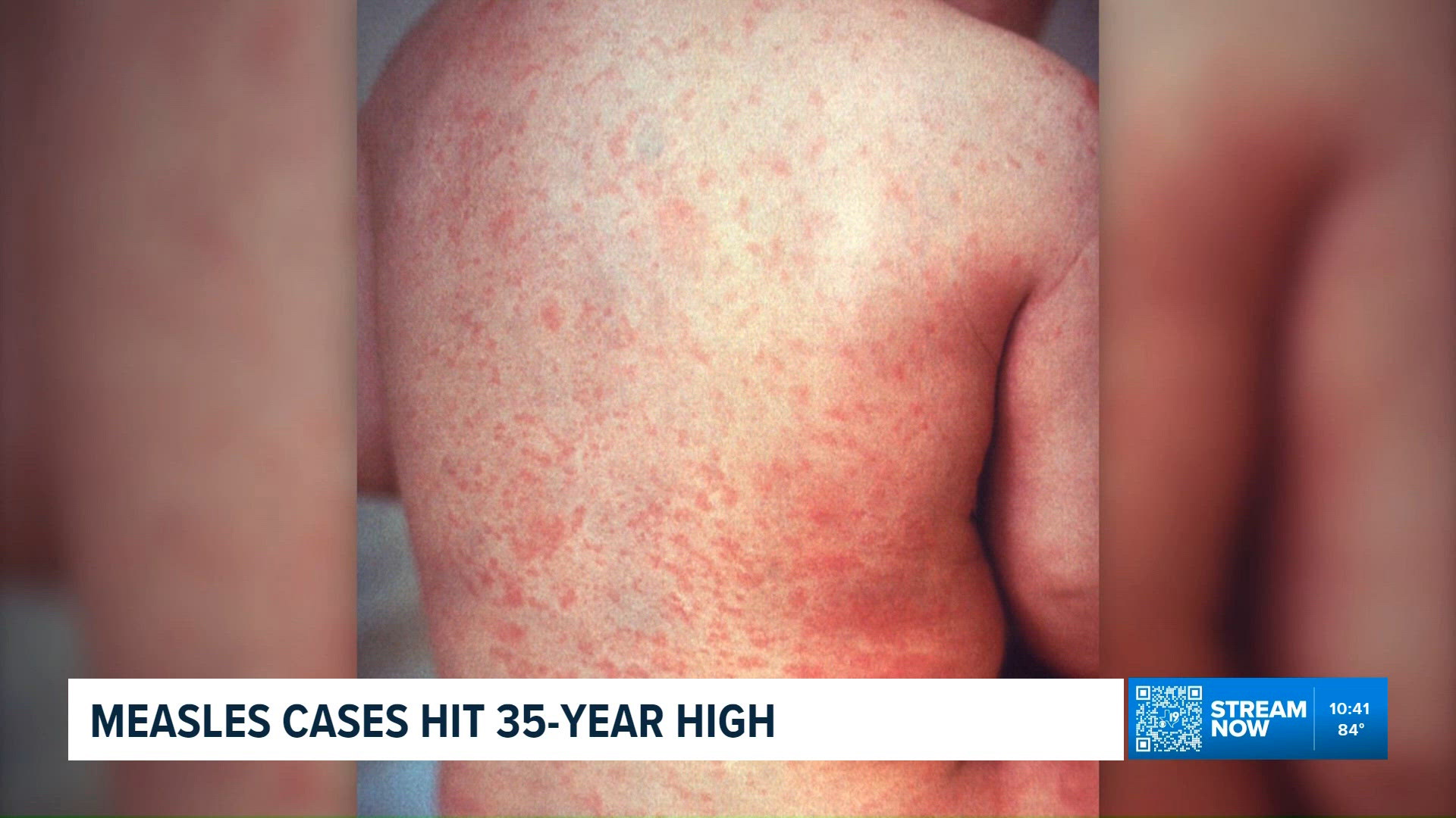 You are currently viewing U.S. measles cases reach their highest level in 35 years