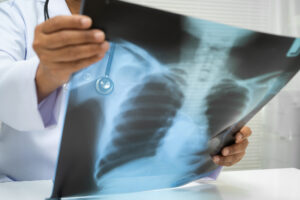 Read more about the article Preventive Tuberculosis Treatment Wanes After One Year in High-Burden Countries, but Lasts for at Least 8 to 13 Years in Low- and Medium-Burden Countries
