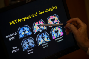 Read more about the article Want to lower your risk of dementia? It doesn’t involve a blood test