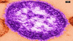 Read more about the article New York state declares a disaster emergency over measles